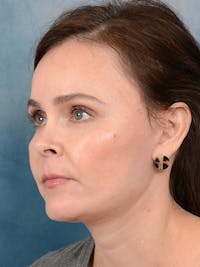 Deep Plane Facelift Before & After Gallery - Patient 26207310 - Image 1