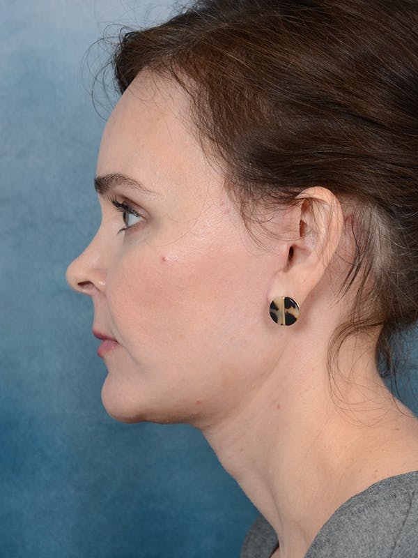 Deep Plane Facelift Before & After Gallery - Patient 26207310 - Image 5