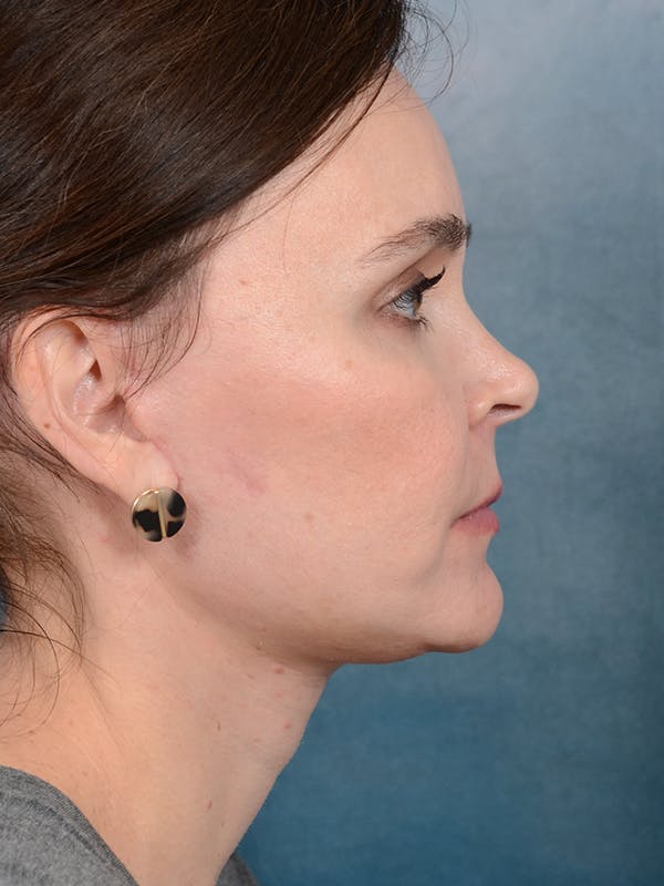 Deep Plane Facelift Before & After Gallery - Patient 26207310 - Image 9