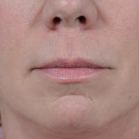 Lip Lift Before & After Gallery - Patient 48086365 - Image 1