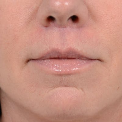 Lip Lift Before & After Gallery - Patient 48086365 - Image 2