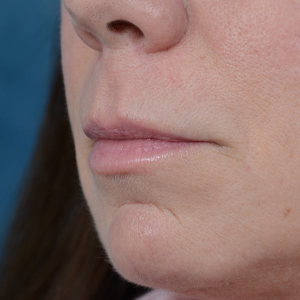Lip Lift Before & After Gallery - Patient 48086365 - Image 3
