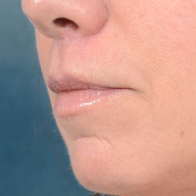 Lip Lift Before & After Gallery - Patient 48086365 - Image 4