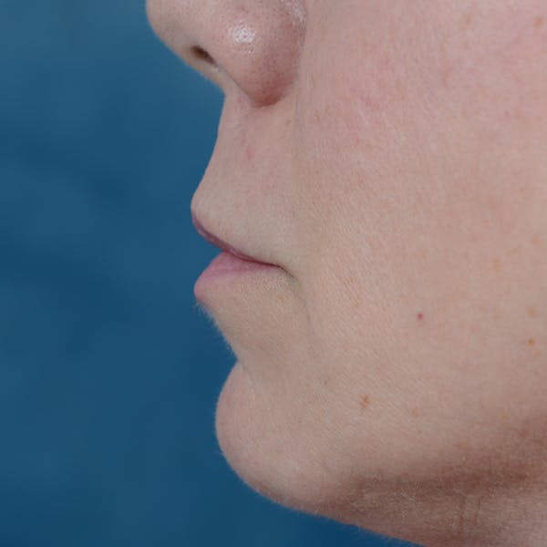 Lip Lift Before & After Gallery - Patient 48086365 - Image 5