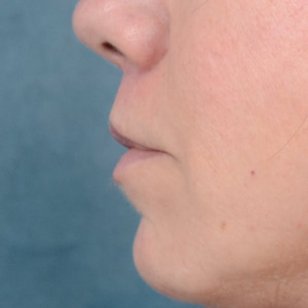 Lip Lift Before & After Gallery - Patient 48086365 - Image 6