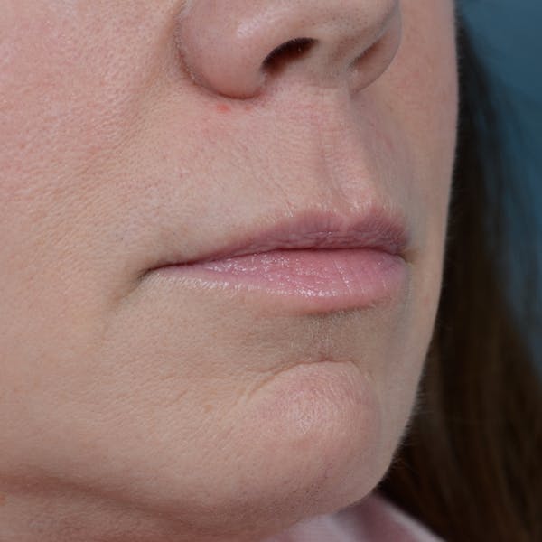 Lip Lift Before & After Gallery - Patient 48086365 - Image 7