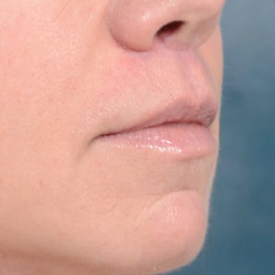 Lip Lift Before & After Gallery - Patient 48086365 - Image 8