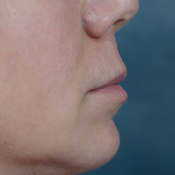 Lip Lift Before & After Gallery - Patient 48086365 - Image 9