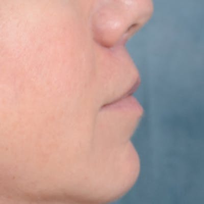 Lip Lift Before & After Gallery - Patient 48086365 - Image 10