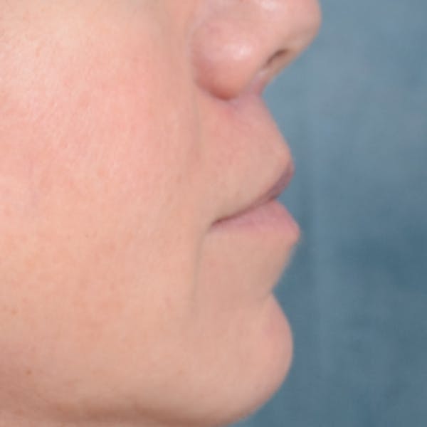 Lip Lift Before & After Gallery - Patient 48086365 - Image 10