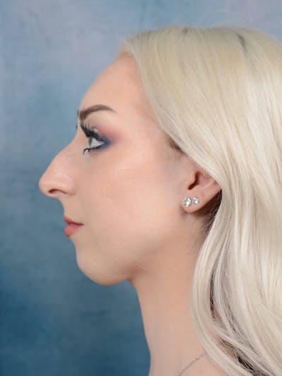 Rhinoplasty Before & After Gallery - Patient 49260523 - Image 1