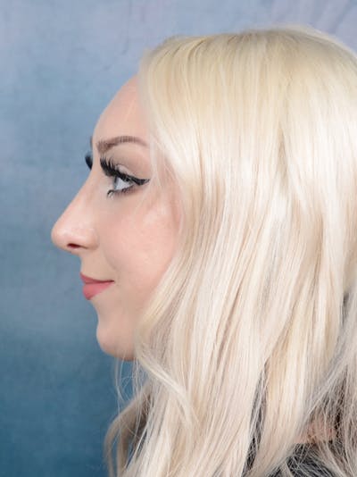 Rhinoplasty Before & After Gallery - Patient 49260523 - Image 2