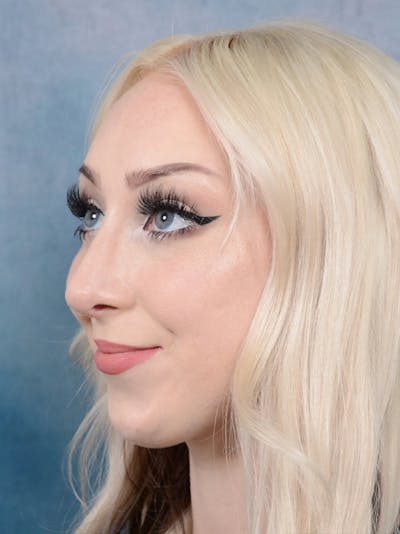 Rhinoplasty Before & After Gallery - Patient 49260523 - Image 4