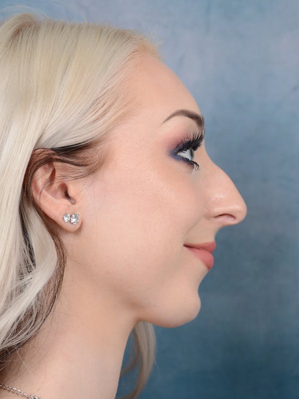Rhinoplasty Before & After Gallery - Patient 49260523 - Image 9