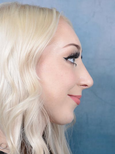 Rhinoplasty Before & After Gallery - Patient 49260523 - Image 10
