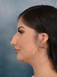 Neck Liposuction