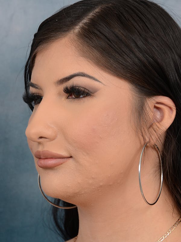 Neck Liposuction