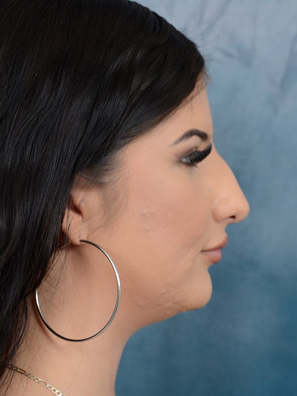 Neck Liposuction