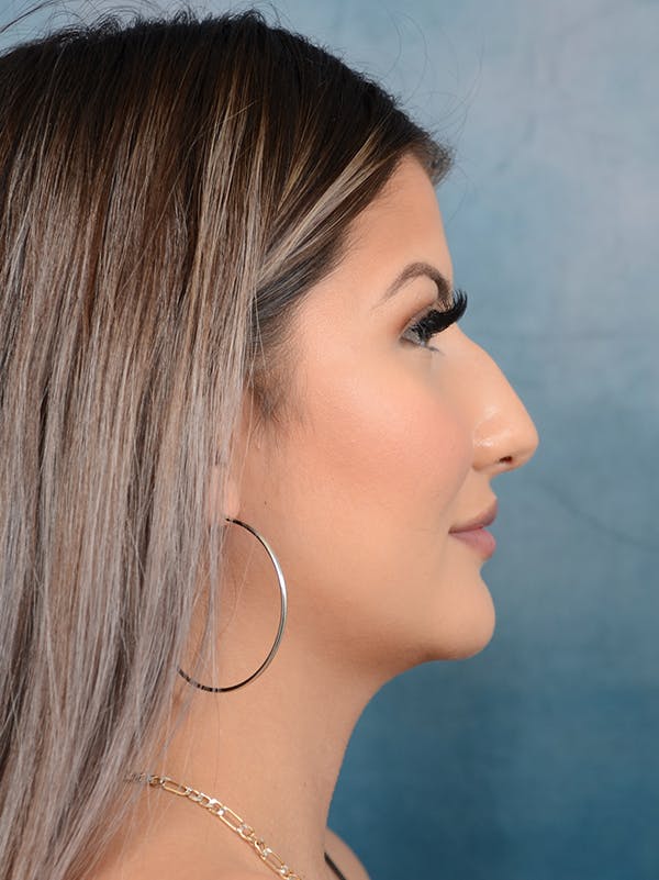 Neck Liposuction