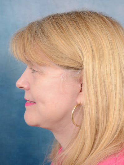 Deep Plane Facelift Before & After Gallery - Patient 54240754 - Image 6