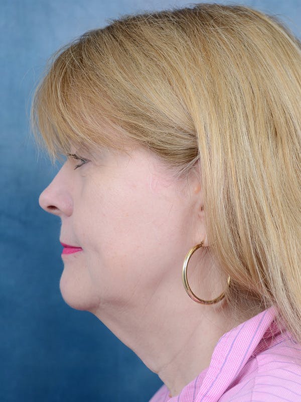 Deep Plane Facelift Before & After Gallery - Patient 54240754 - Image 5