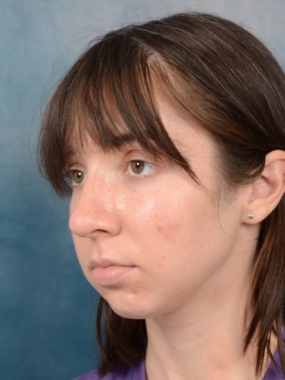 Rhinoplasty Before & After Gallery - Patient 54248944 - Image 6