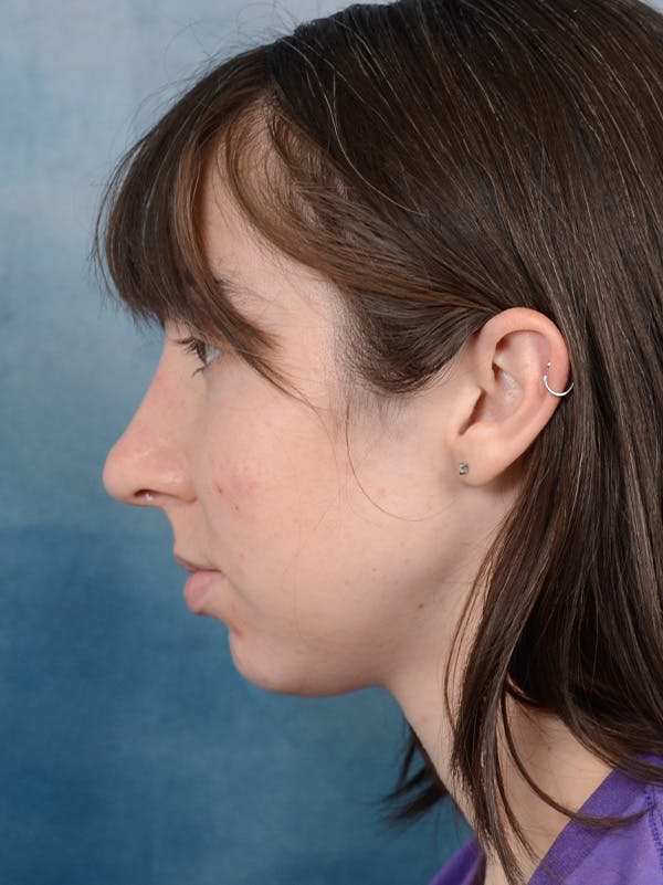 Rhinoplasty Before & After Gallery - Patient 54248944 - Image 2