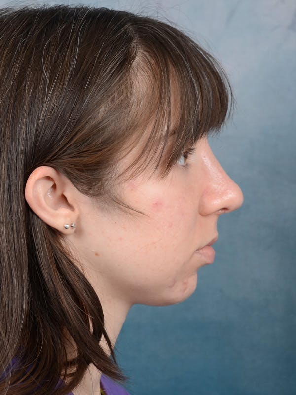 Rhinoplasty Before & After Gallery - Patient 54248944 - Image 10