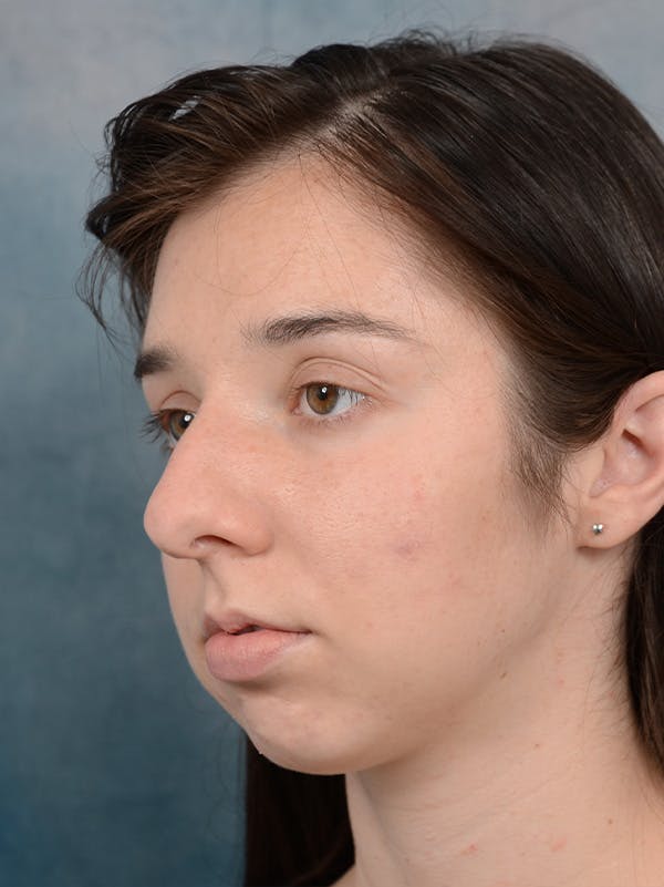 Rhinoplasty Before & After Gallery - Patient 54248944 - Image 5
