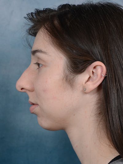 Rhinoplasty Before & After Gallery - Patient 54248944 - Image 1