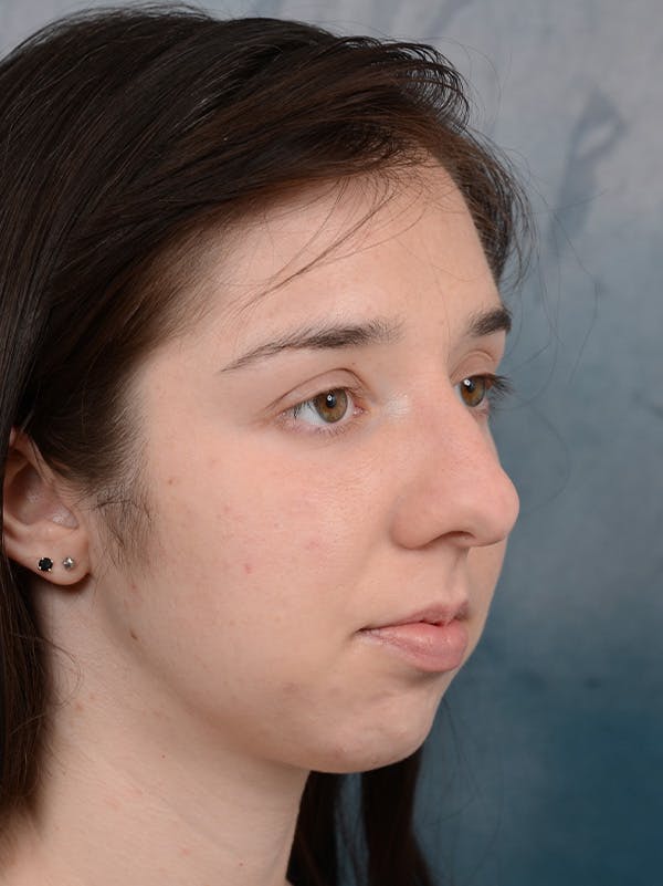 Rhinoplasty Before & After Gallery - Patient 54248944 - Image 7