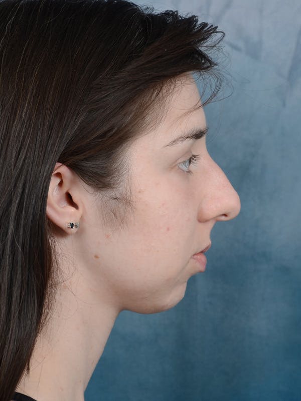 Rhinoplasty Before & After Gallery - Patient 54248944 - Image 9