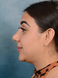 Rhinoplasty Before & After Gallery - Patient 56163162 - Image 1