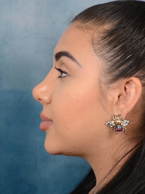 Rhinoplasty Before & After Gallery - Patient 56163162 - Image 2