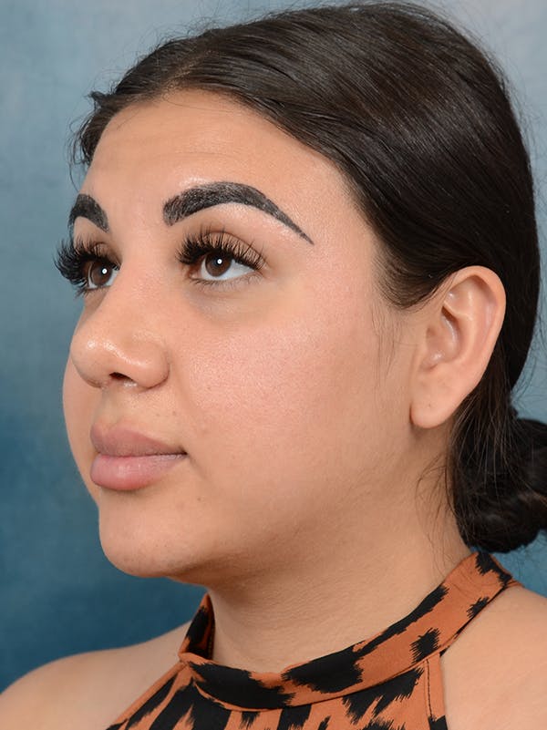 Rhinoplasty Before & After Gallery - Patient 56163162 - Image 3