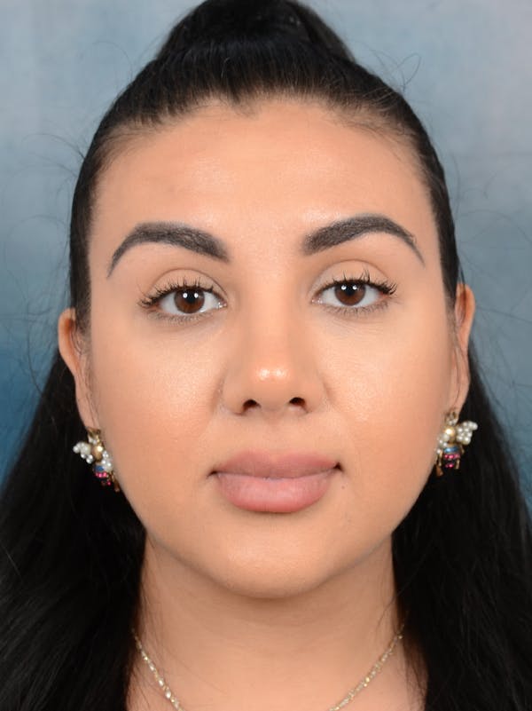 Rhinoplasty Before & After Gallery - Patient 56163162 - Image 6