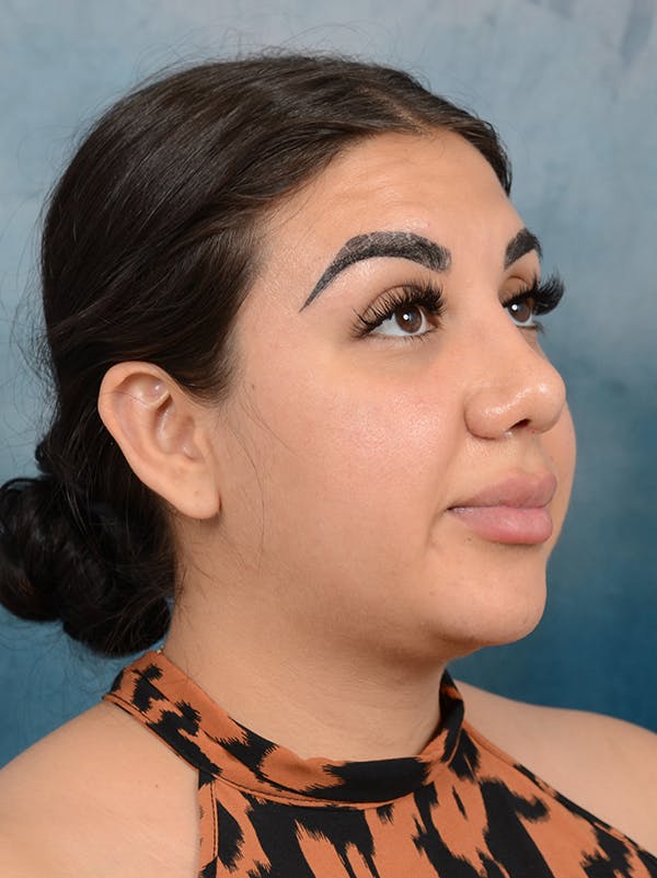 Rhinoplasty Before & After Gallery - Patient 56163162 - Image 7