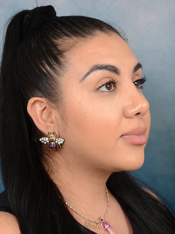 Rhinoplasty Before & After Gallery - Patient 56163162 - Image 8