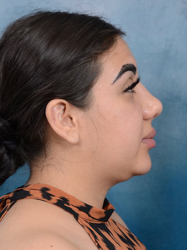 Rhinoplasty Before & After Gallery - Patient 56163162 - Image 9