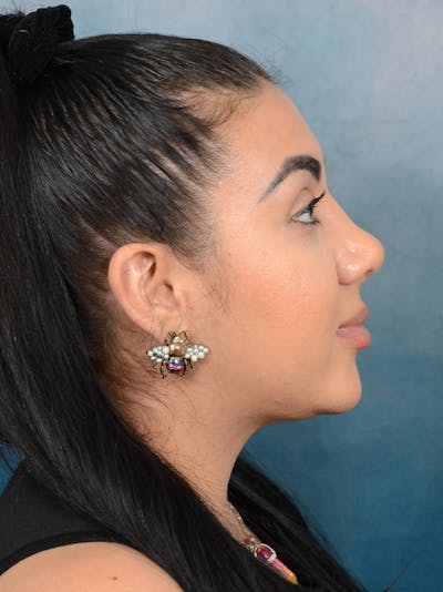 Rhinoplasty Before & After Gallery - Patient 56163162 - Image 10