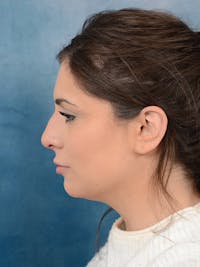Rhinoplasty Before & After Gallery - Patient 56163161 - Image 1