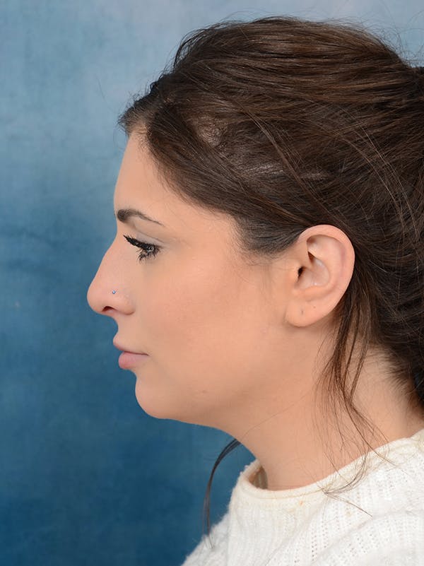 Rhinoplasty Before & After Gallery - Patient 56163161 - Image 1