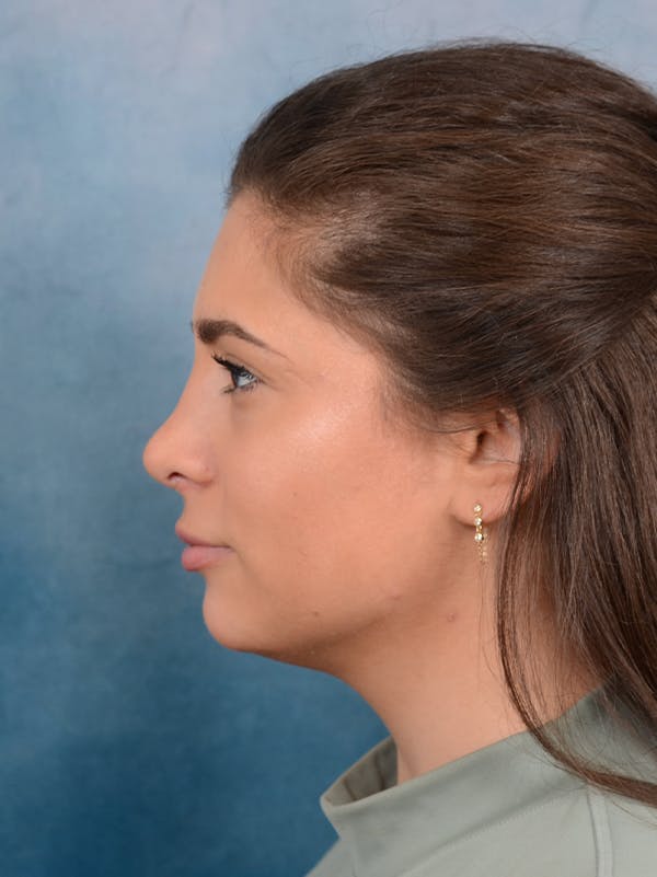 Rhinoplasty Before & After Gallery - Patient 56163161 - Image 2