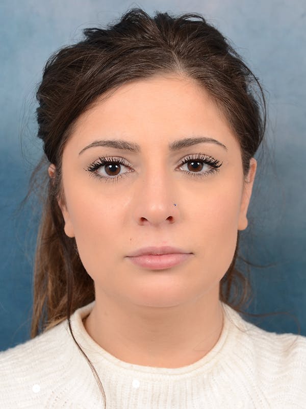 Rhinoplasty Before & After Gallery - Patient 56163161 - Image 5