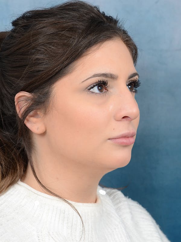 Rhinoplasty Before & After Gallery - Patient 56163161 - Image 7