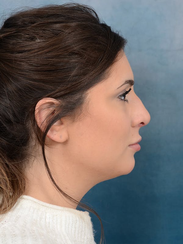 Rhinoplasty Before & After Gallery - Patient 56163161 - Image 9