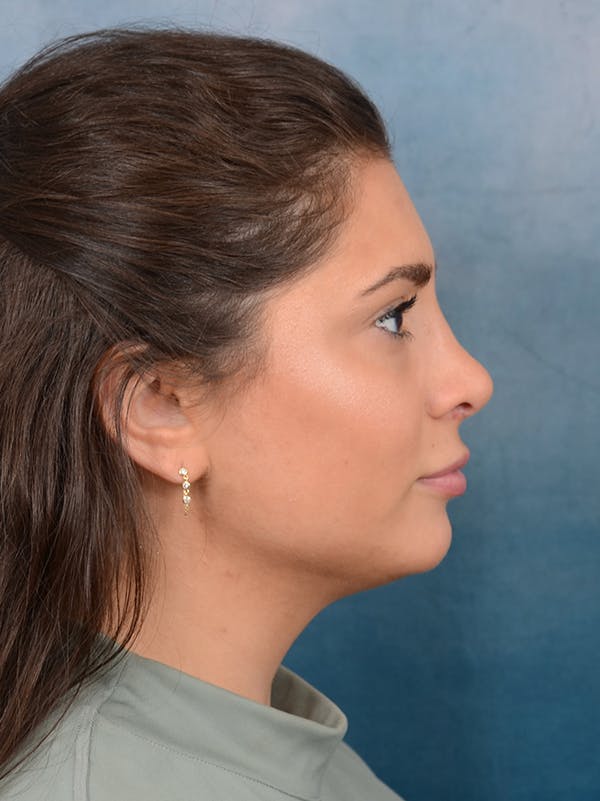 Rhinoplasty Before & After Gallery - Patient 56163161 - Image 10