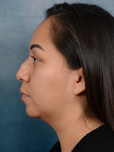 Rhinoplasty Before & After Gallery - Patient 57576535 - Image 1