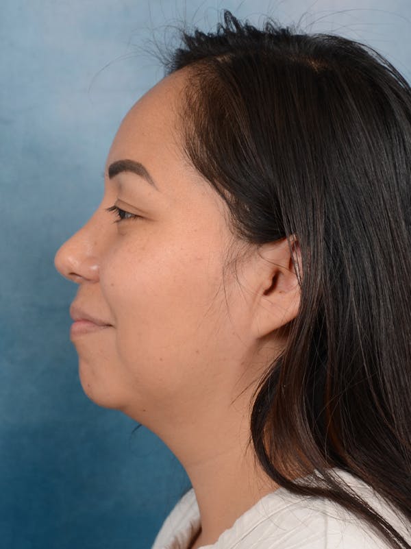 Rhinoplasty Before & After Gallery - Patient 57576535 - Image 2
