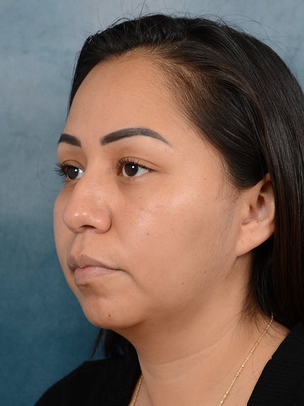 Rhinoplasty Before & After Gallery - Patient 57576535 - Image 5